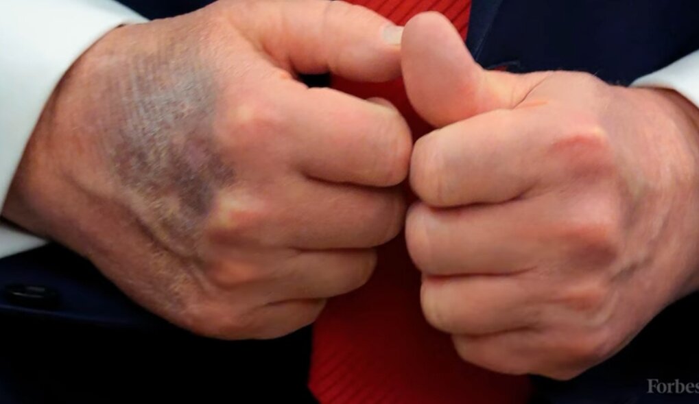 Donald Trump: Stručnjaci objašnjavaju modrice na rukama i otoke na zglobovima